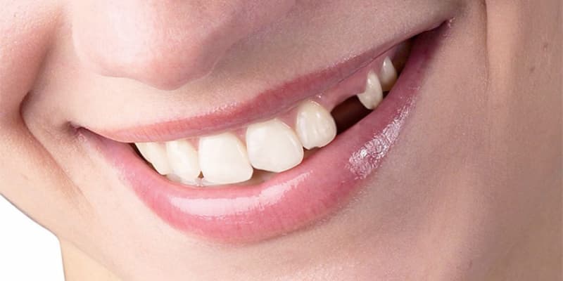 Nguyên nhân việc thấy gãy răng trong giấc ngủ có thể là do tâm lý không ổn định